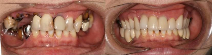 ジルコニアククラウン