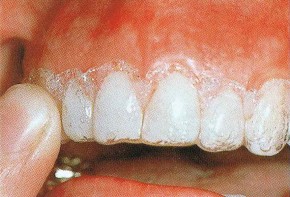 ホワイトニング