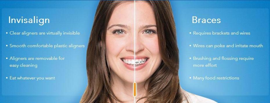 インビザライン