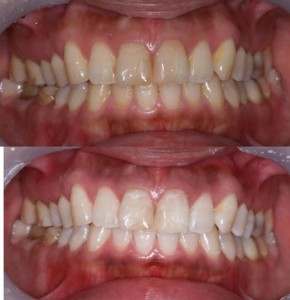 ホワイトニング