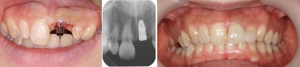 ジルコニアククラウン