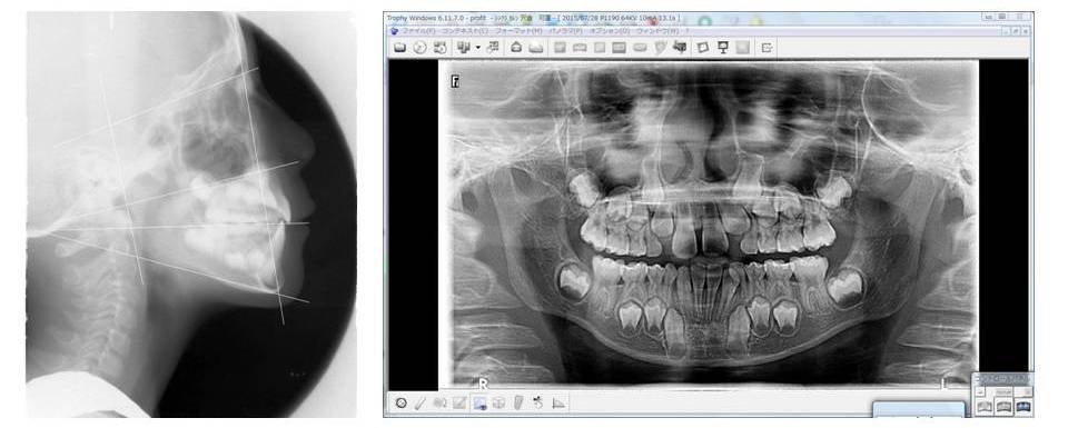 小児矯正 小児矯正
