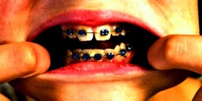 インビザライン