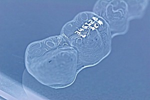 インビザライン