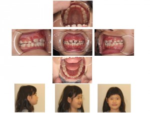 小児矯正 小児矯正