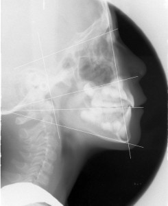 インビザライン