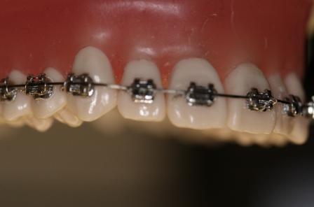 インビザライン