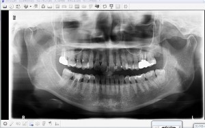インビザライン