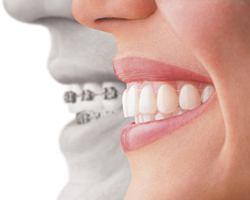 インビザライン