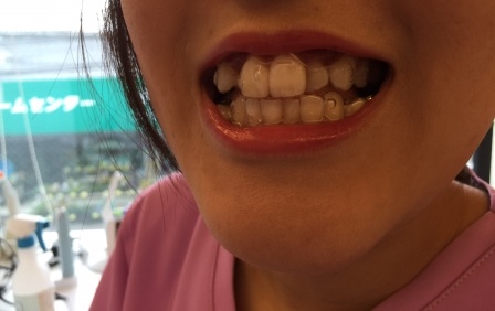 インビザラインレポート